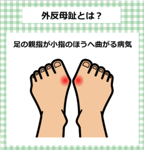 外反母趾