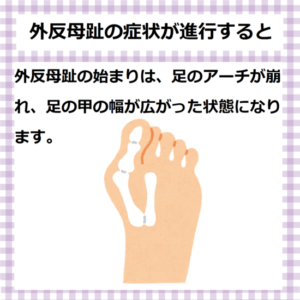 外反母趾が進行